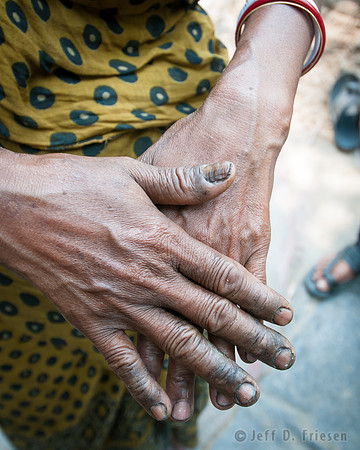 Arsenic Poisoning Effects - Hands 2